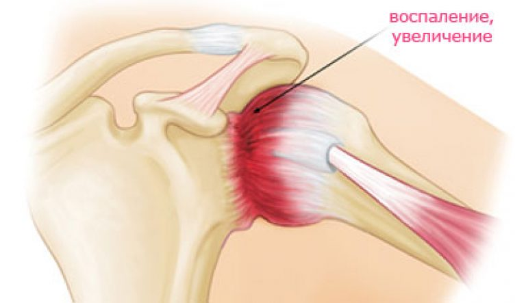 Дома плечелопаточный периартрит. Плечелопаточный периартрит артроз. Периартроз плечевого сустава. Поечелопаточный периартроз.