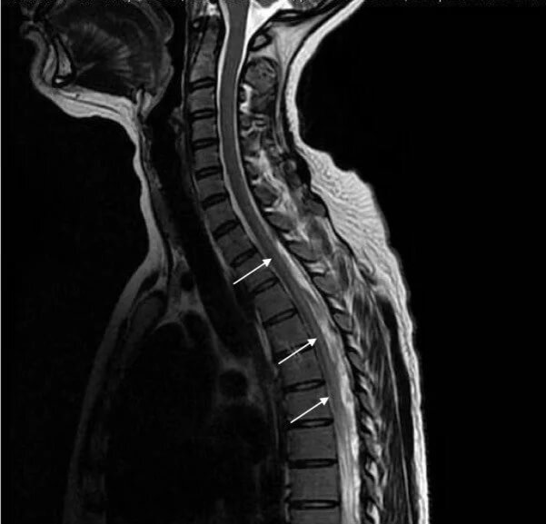 МРТ спинного мозга (она же МР-миелография) - это прицельное обследование спинного мозга и мозговых оболочек.
