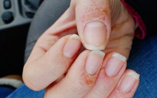 Аллергическая реакция на искусственный материал.