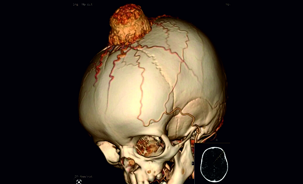 Данные компьютерной томографии младенческой гемангиомы теменной области. Гемангиома распространяется только в мягкие ткани и не повреждает костную ткань и не прорастает в головной мозг. Источник:  https://radrounds.com/radiology-case-images-teaching-file/infantile-haemangioma-3d/