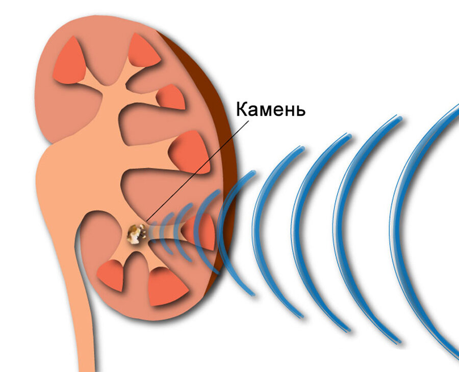 Дробление камня в почке лазером