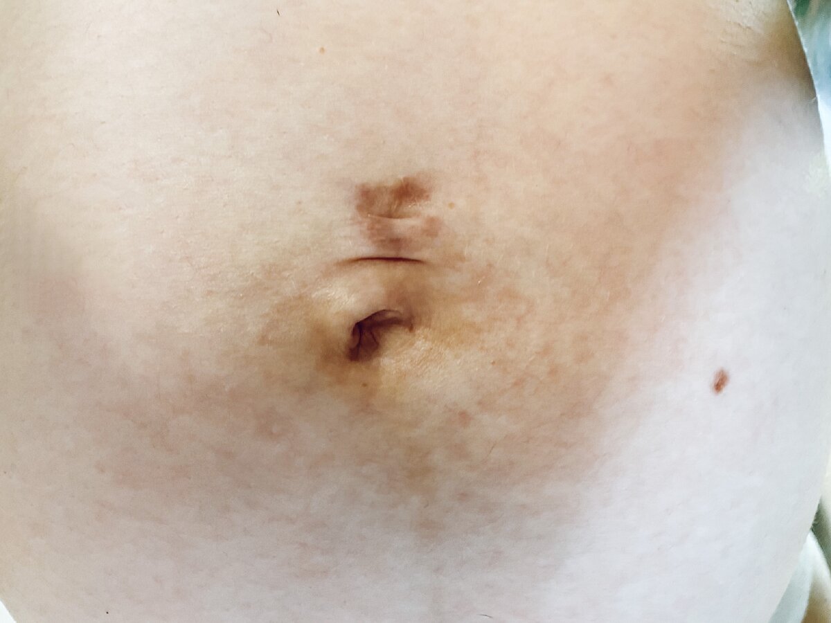 Так сейчас выглядит мой пупок без сережки