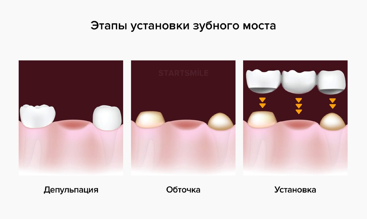 Мосты вместо зубов