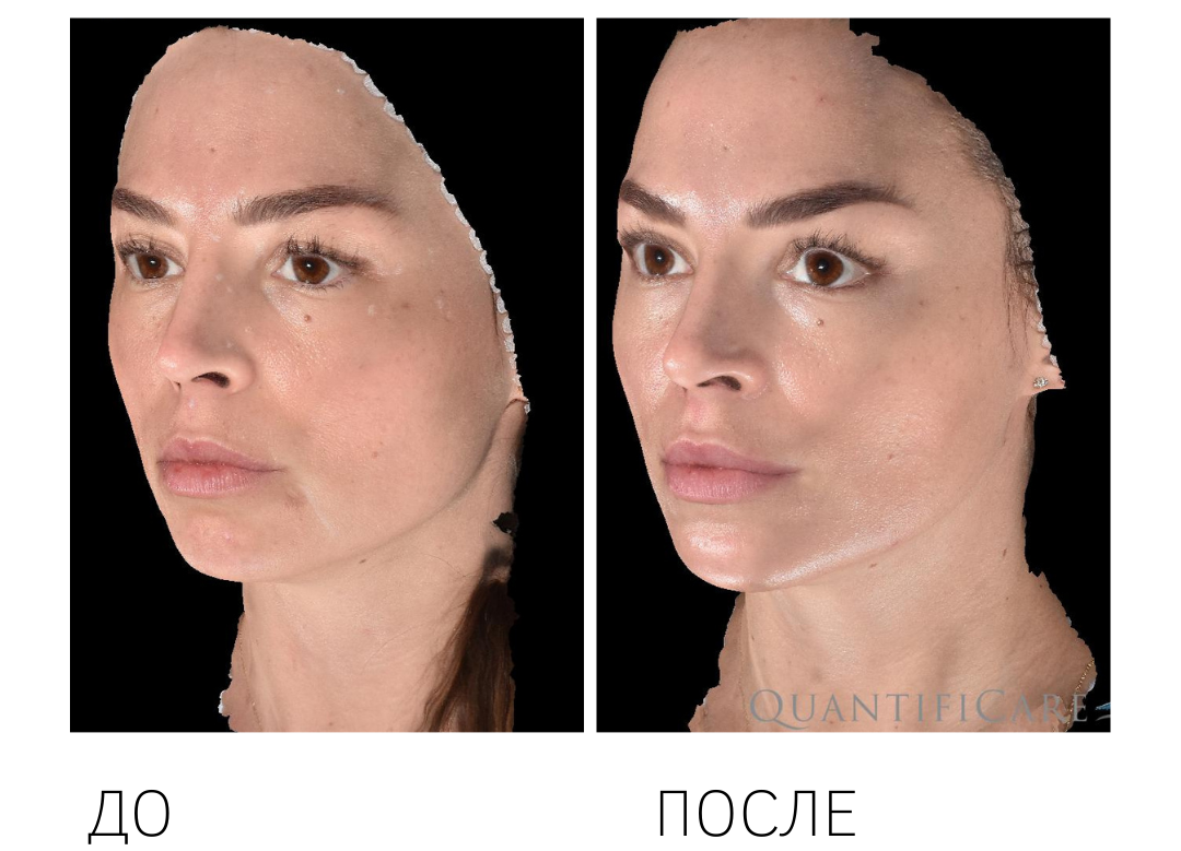 Авторская методика "Подтянутое лицо". Ксеомин 75 ед.