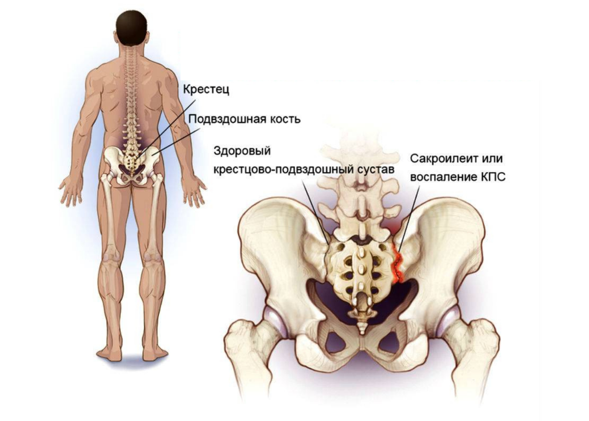 Arthritis associated with the inflammatory intestinal diseases