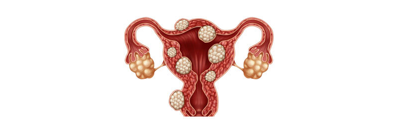 Доброкачественные опухоли матки