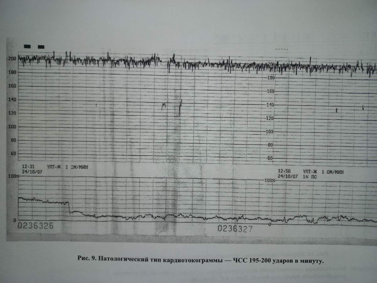 На фото патологическая КТГ , тахикардия у плода , частота сердечных сокращений повышена 195 - 200 уд в мин