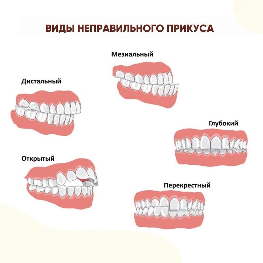 Виды прикуса схема