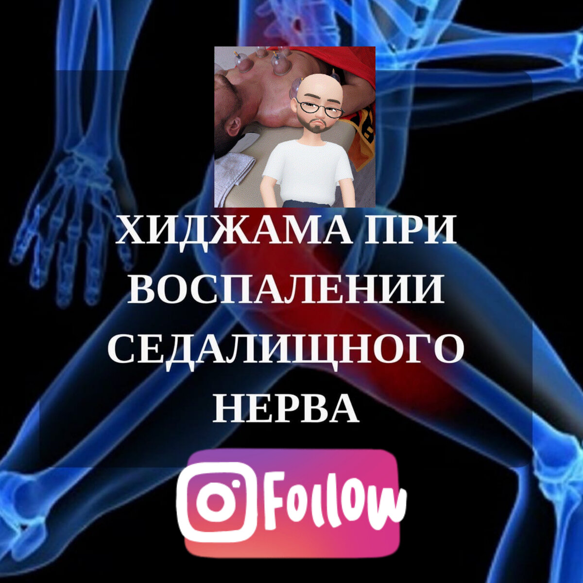 В последние годы от неврологических заболеваний страдает все больше и больше людей. Больные жалуются на тянущие болевые симптомы в спине, пояснице и области ягодиц. Неприятные ощущения могут опускаться к ногам. Такие признаки указывают на защемление и, как следствие, воспаление седалищного нерва. 
⠀ 
📌Основные причины: 
⠀ 
▫Смещение межпозвоночного диска, сопровождающееся защемлением седалищного нерва; 
⠀ 
▫Сужение позвоночного канала, наросты на позвоночнике; 
⠀ 
▫Синдром грушевидной мышцы; 
⠀ 
▫Повреждения органов либо мышечного аппарата малого таза вследствие травм или тяжелых физических нагрузок; 
⠀ 
▫Переохлаждение, инфекционные процессы; 
⠀ 
▫Наличие новообразований; 
⠀ 
▫Наличие серьезных заболеваний (инфекции, сахарный диабет); 
⠀ 
▫Избыточный вес. 
⠀ 
👉🏻Для уточнения диагноза необходимо проведение комплексного обследования пациента. 
⠀ 
📌Если вовремя не начать лечение, болезнь приводит к тяжёлым последствиям: нестабильности позвонков, отмиранию нервных окончаний, атрофии органов малого таза, выраженной слабости мышц в ногах, параличу ног. 
⠀ 
✅При лечении воспалении седалищного нерва, помимо других действий, направленных на оздоровление, мы рекомендуем подключить хиджаму. 
⠀ 
✅Хиджама обогащает соединительную ткань полезными веществами, способствует расслаблению спазмированных мышц, нормализует кровоснабжение костно-суставного аппарата. 
⠀ 
✅После процедуры организм вырабатывает новую кровь, которая способствует снятию воспаления, питанию и регенерации суставов и хрящевых тканей, устранению болевых ощущений.