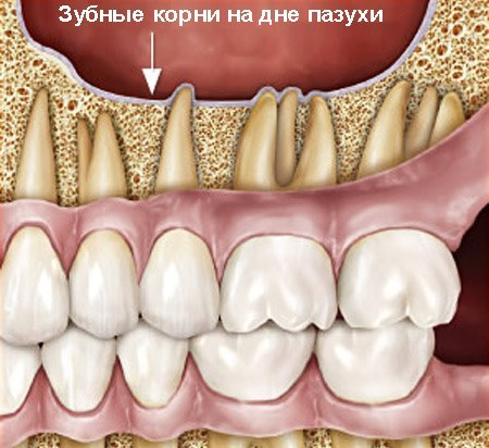 Одонтогенный гайморит. Кто должен лечить: стоматолог или лор-врач?