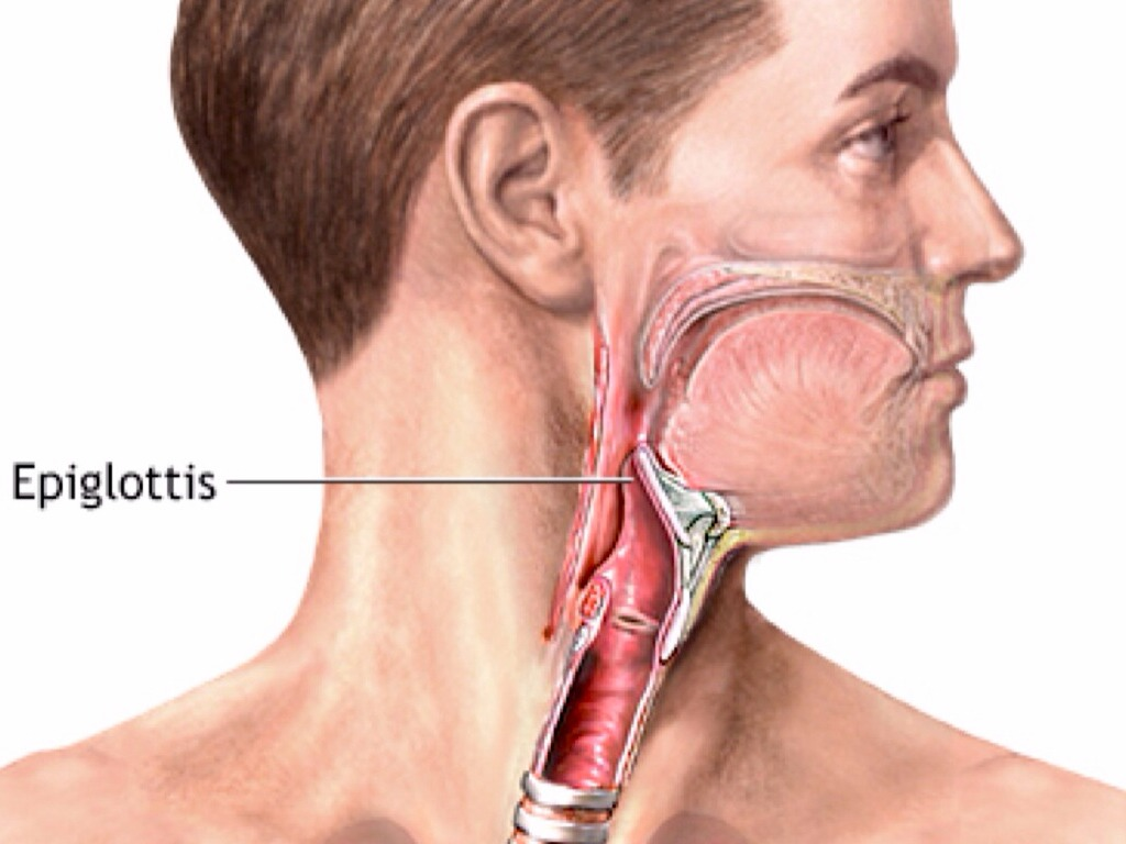 Эпиглоттит надгортанник. Эпиглоттит воспаление надгортанника. Эпиглоттит эпиглоттит острый что это.