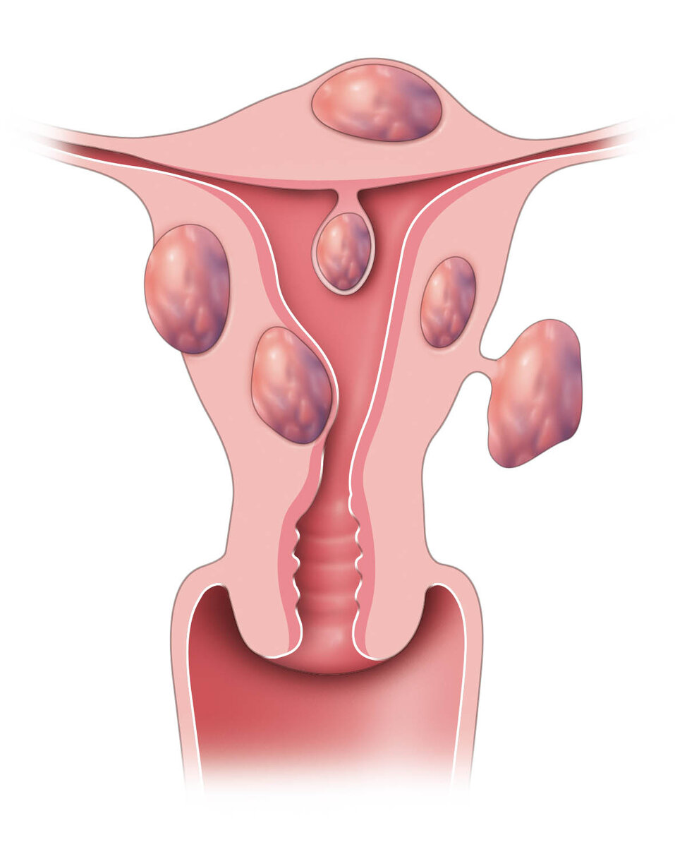 Миомы и фибромиомы матки. Миома киста шейки матки. Миома киста шейки матки. Субсерозный узел матки. Парацервикальные кисты.