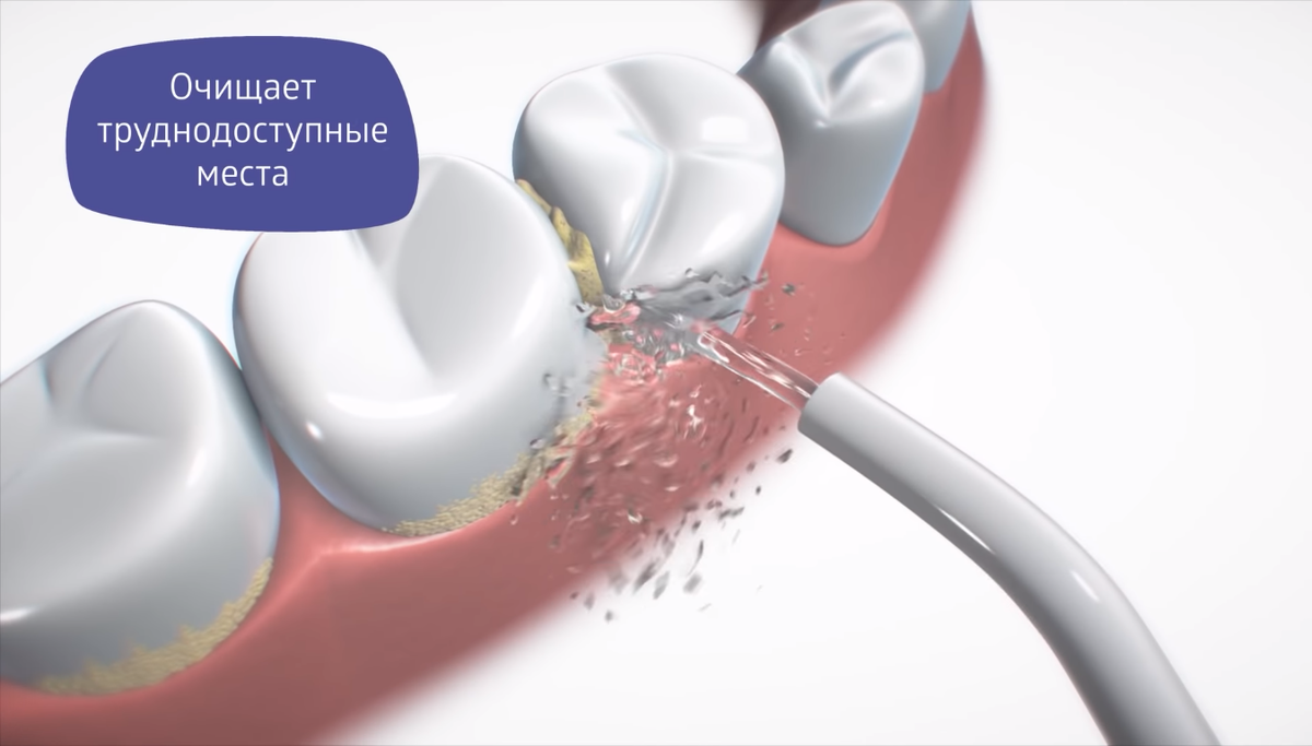 Ирригатор эффективнее зубных нитей и ополаскивателей