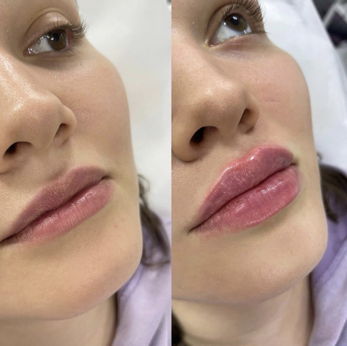«До» контурной пластики губ и «После».