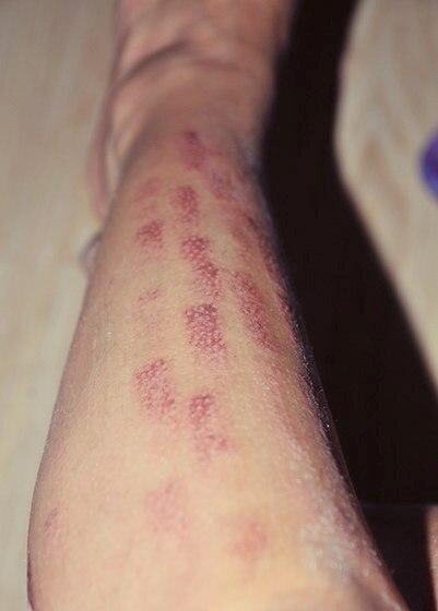 Тоже ожоги. С настройками лазера здесь ошиблись очень сильно