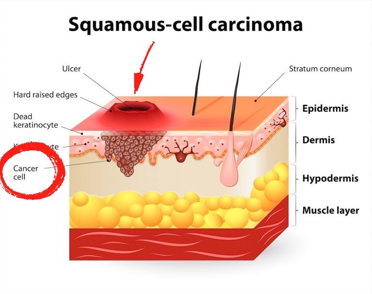 Cancer cell — опухолевые клетки