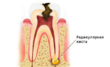 Образование шишки на десне