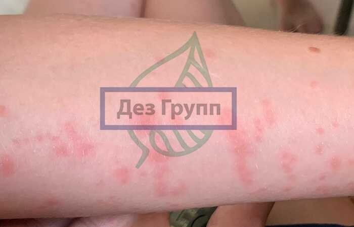 Укусы постельного клопа