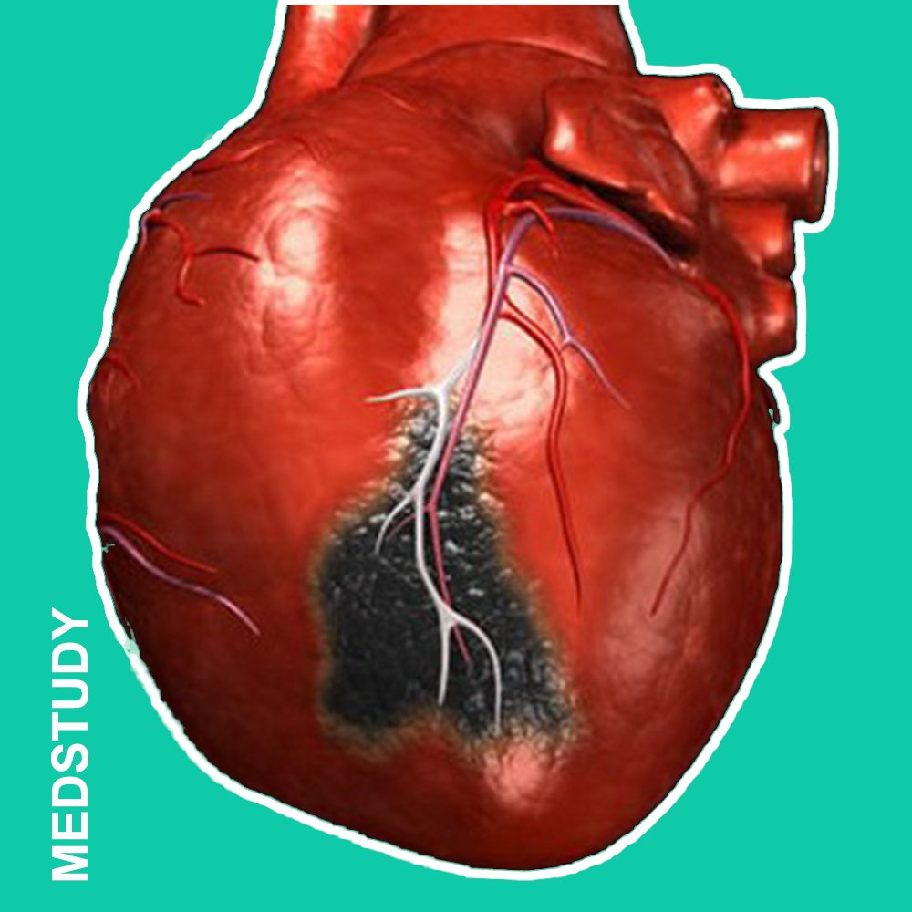 Некроз части сердечной мышцы