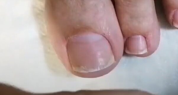 Нет подногтевых мозолей, ногтевая пластина нормально сидит в пазухах, не повреждена фрезами и не оторвана от ногтевого ложа. Между ногтевой пластиной и кожной складкой (то есть сбоку под ноготь) невозможно завести инструмент - анатомическая норма.