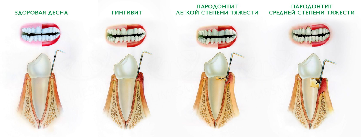 Воспаление десен