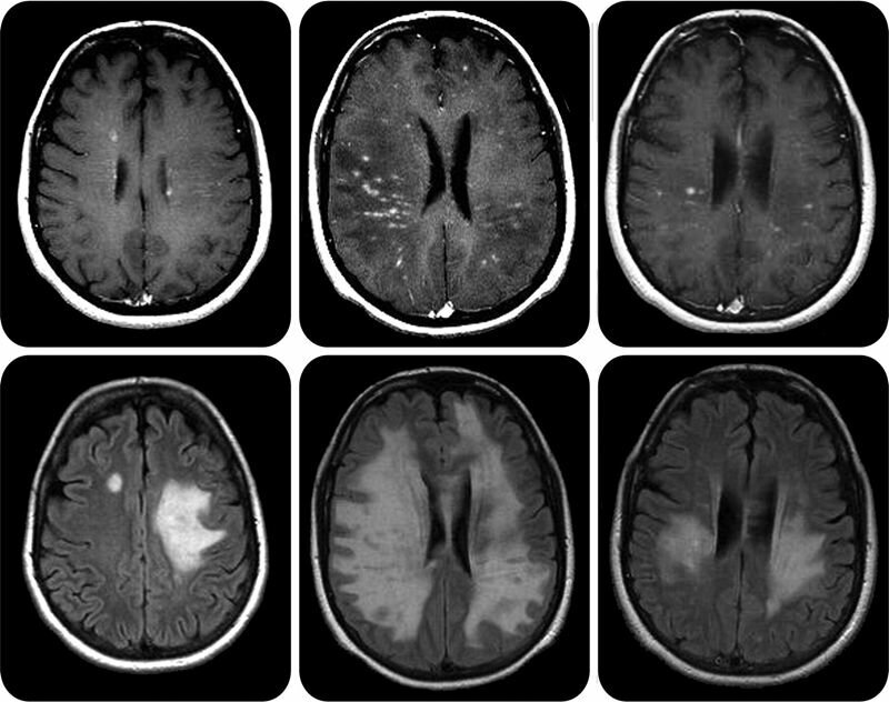 Мр картина демиелинизирующего заболевания головного мозга