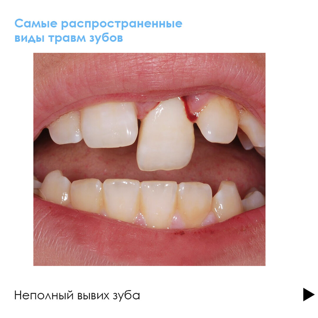 Травма зуба у ребенка? 🦷 Скорее к стоматологу!⠀ | Клиника Здоровья Исток |  Дзен