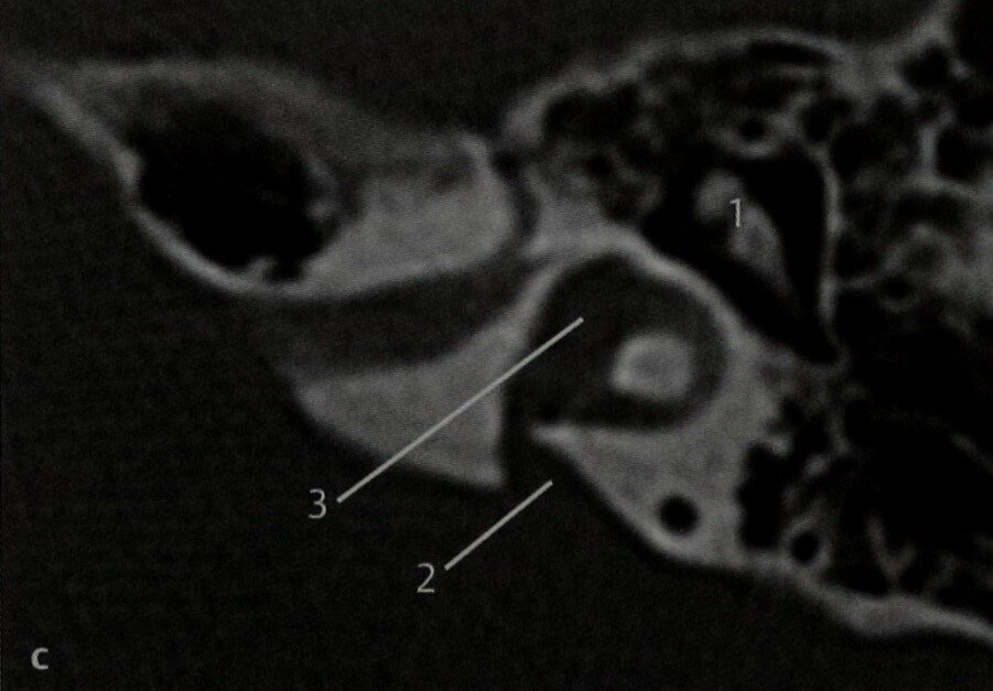 Сделать кт уха. Холестеатома сосцевидного отростка кт. Холестеатома среднего уха на кт. Холестеатома височной кости мрт. Анатомия среднего уха на кт.