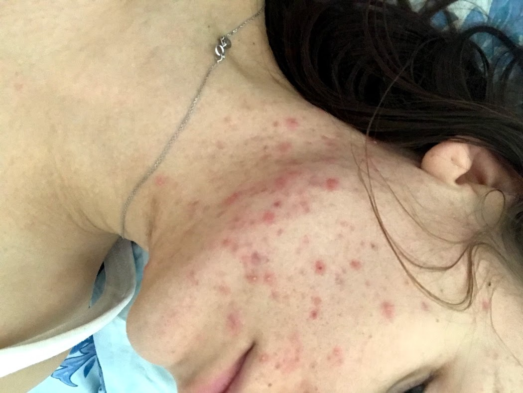 Акне во время беременности