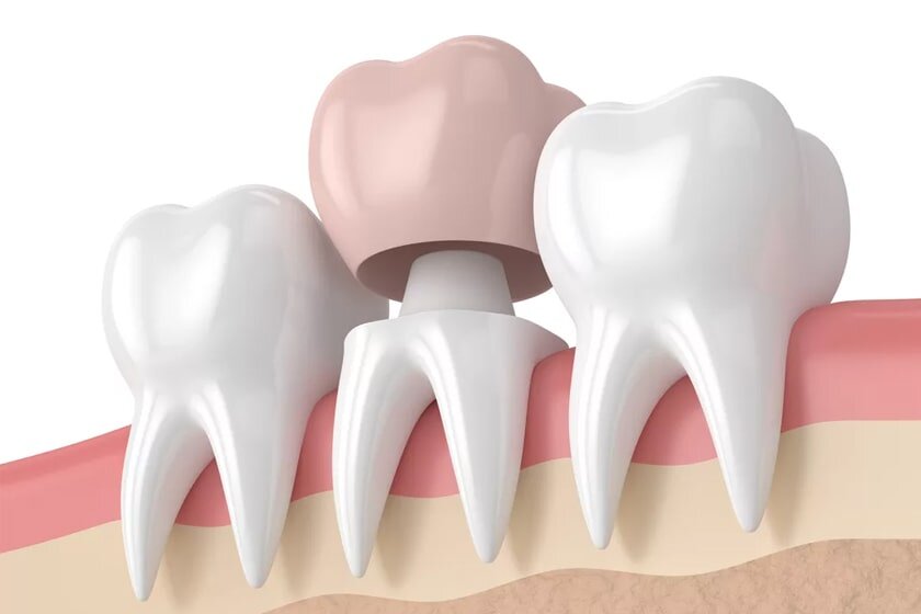 Как зубная коронка защищает зуб?