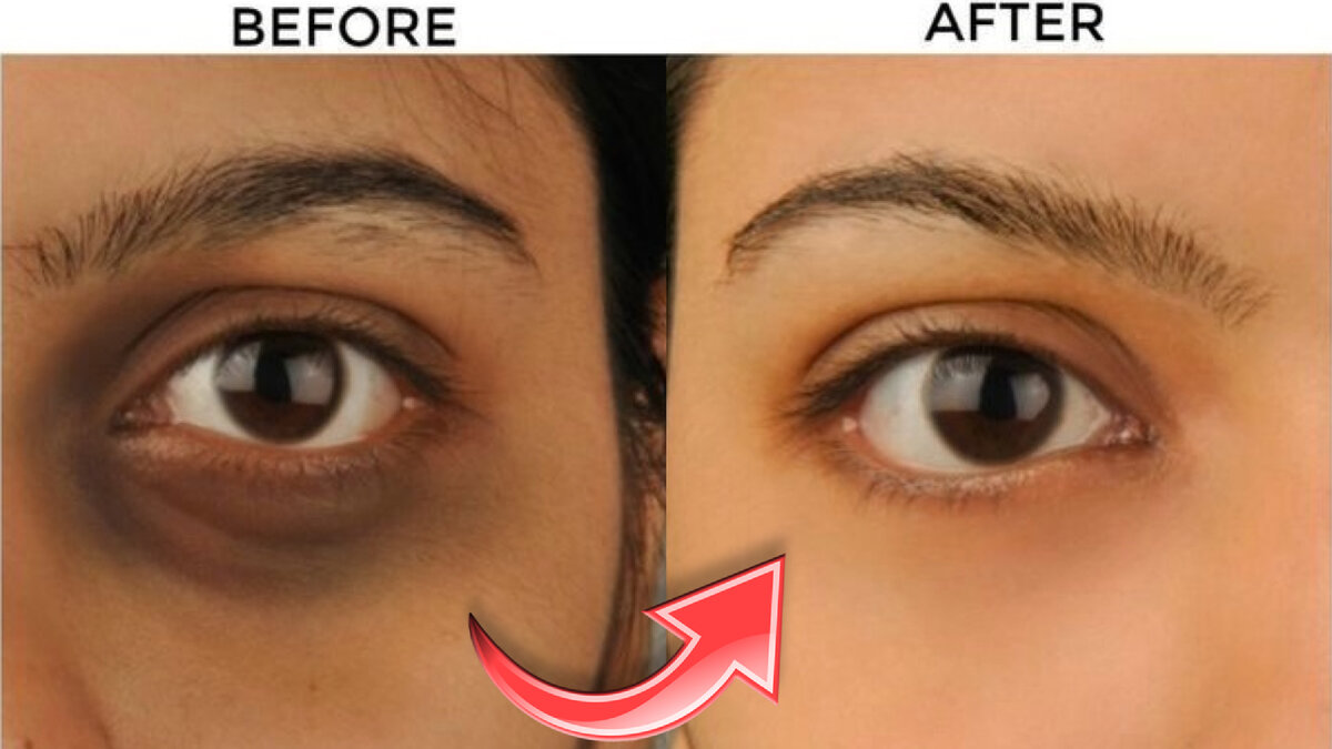 #уход за лицом #темные круги под глазами #морщины #мешки под глазами 