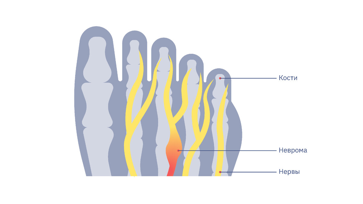 Qué significa neuroma de morton