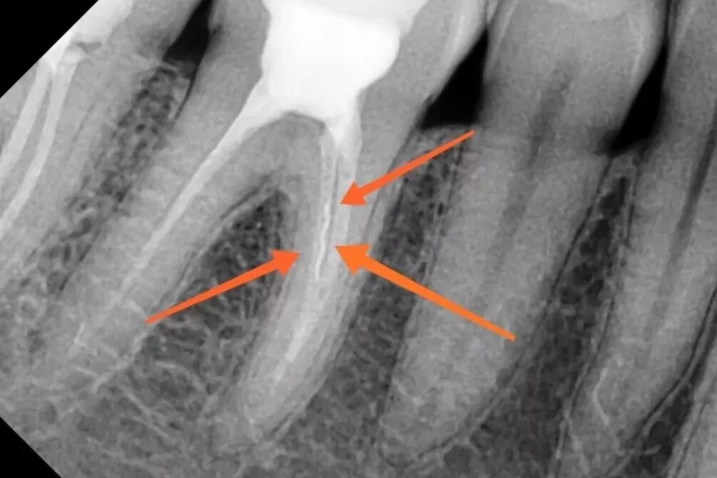 Хроническая трещина форум. Перелом корня зуба рентген. Обтурация корневого канала рентген. Перфорация корня зуба снимок.