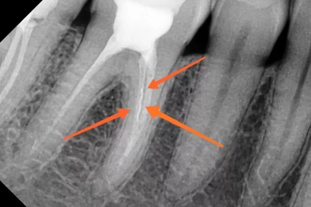 Перфорация корня зуба. Отлом эндодонтического инструмента в канале корня. Перфорация корня зуба снимок.