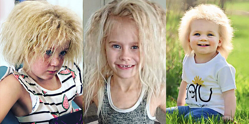 Дети с синдромом нерасчесываемых волос