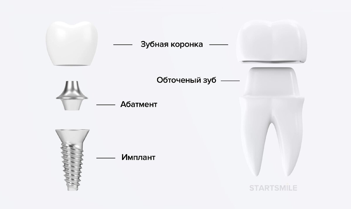 Коронка на передний зуб схема