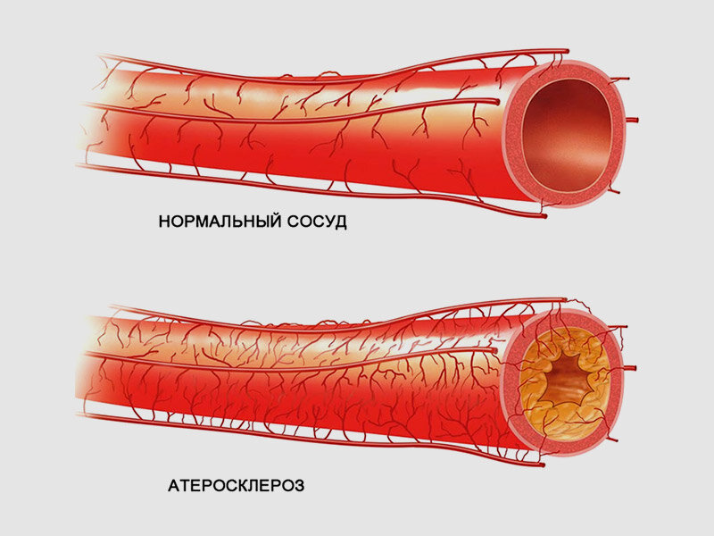 Системная склеродермия (ССД)