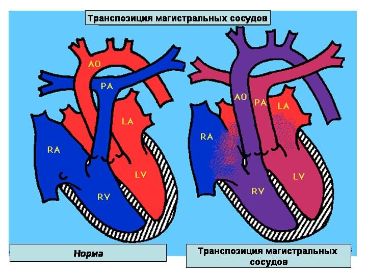 Транспозиция магистральных сосудов