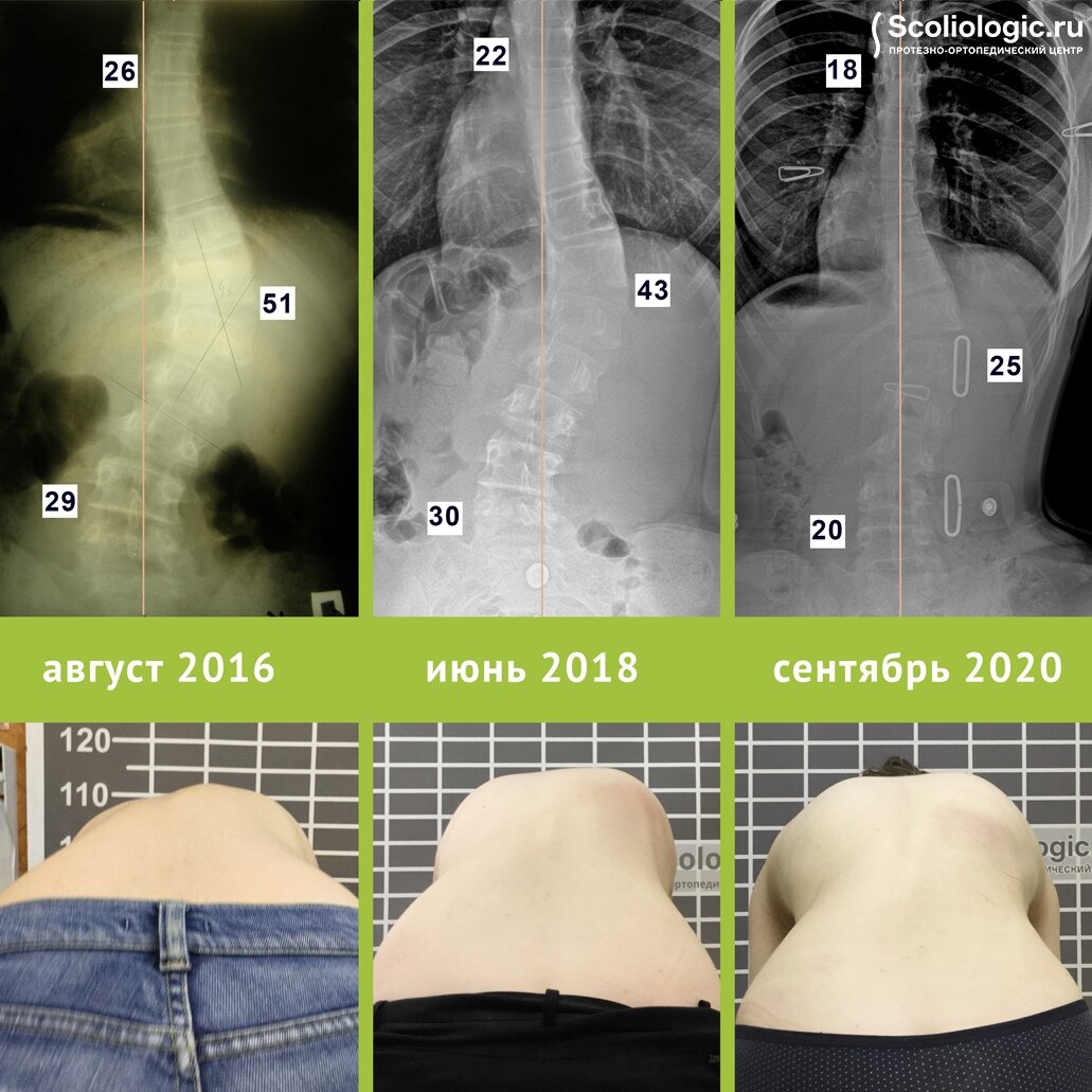 Комплексное лечение сколиоза