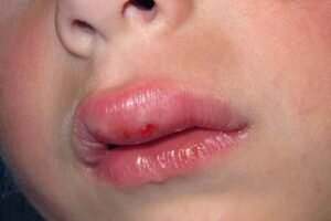 Ударил/прикусил губу,чем намазать? — 7 ответов | форум Babyblog