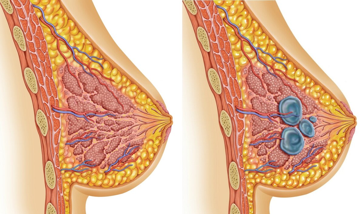 Фиброзно-кистозная мастопатия | Доктор Гульнара Мазитова | Дзен