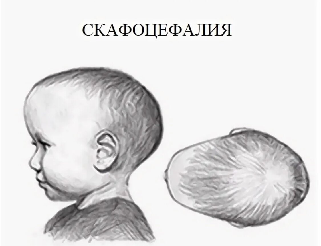 Затылок у малышей. Долихоцефалическая форма головы у новорождённых. Форма головы скафоцефалия. Скафоцефалическая форма головы у новорожденного. Сагиттальный краниостеноз.