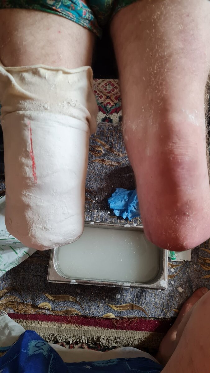 Процесс снятия слепков при парной ампутации конечностей.