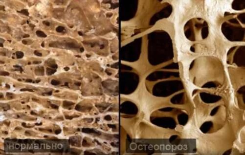 Остеопороз - заболевание, при котором снижается прочность и масса костей, приводя к хрупкости и переломам.