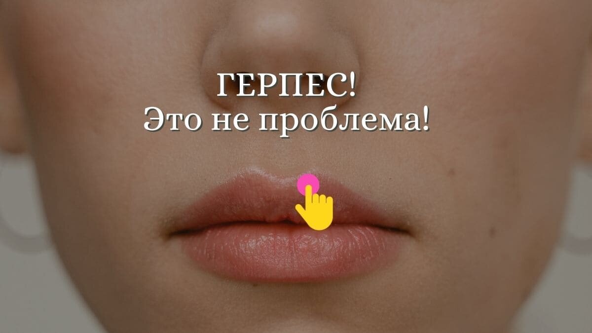 Герпес на губах: профилактика и лечение | "о Женском" онлайн-журнал | Дзен