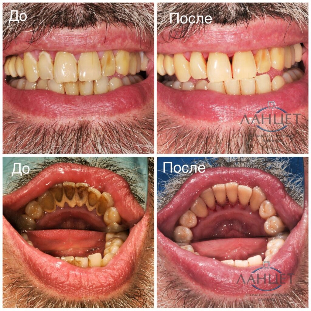 Профессиональная гигиена зубов.  Снятие твёрдых зубных отложений - камня ультразвуком. Снятие налета Air-flow
Врач Маслеников В.А. 