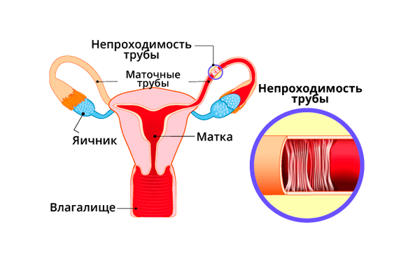 Спермограмма по Крюгеру