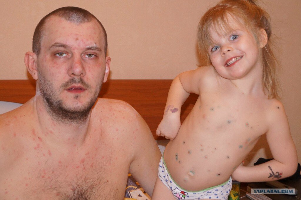 ветрянка у взрослого  папы и маленькой дочери.