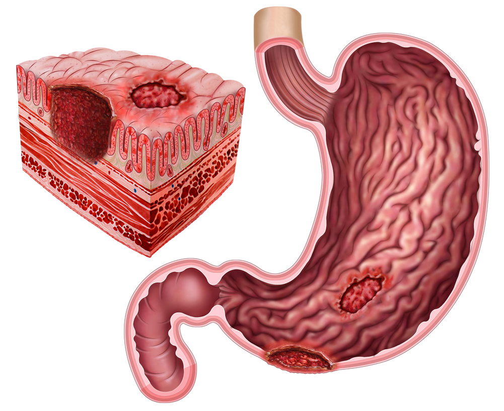 Возникновение язвы желудка