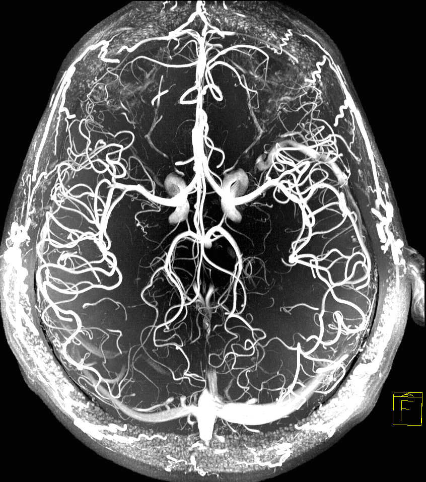 Названия сосудов головного мозга. Магнитно-резонансная ангиография сосудов головного мозга. Мрт ангиография сосудов головного мозга. Кт ангиограмма сосудов головного мозга. Мрт венография сосудов головного мозга.